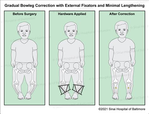 midget feet|Dwarfism (Skeletal Dysplasia) & Other Causes of Short Stature.